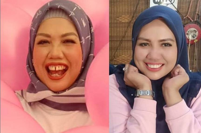 Elly Sugigi sebelum dan sesudah potong gigi