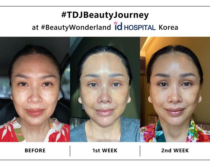 Perubahan drastis wajah Tito DJ setelah lakukan oprasi anti aging