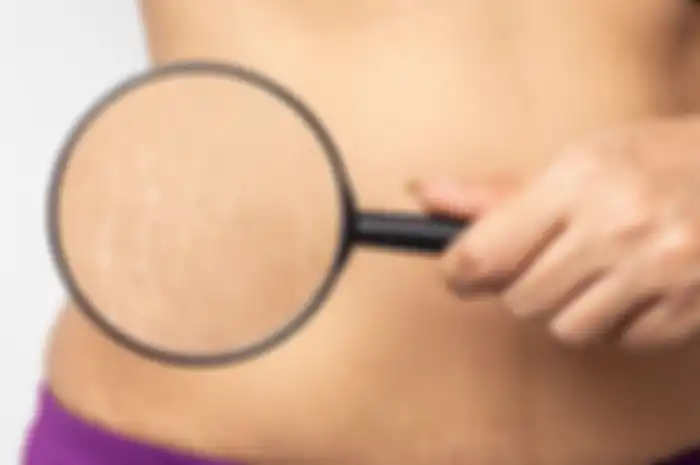 Cara Hilangkan Stretch Mark Pakai Bahan Alami 