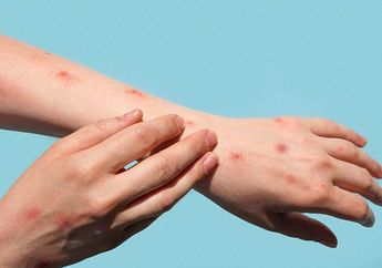 Kasus Cacar Monyet Pertama di Indonesia Ditemukan di Jakarta, Kemenkes Ungkap Kronologi Penemuannya, Berawal dari Kecurigaan Seorang Perawat