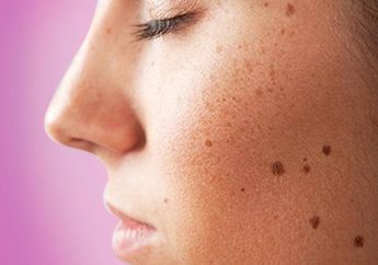 Singkirkan Bintik Hitam di Wajah dengan Umbi-umbian Satu Ini, Mau Tahu?