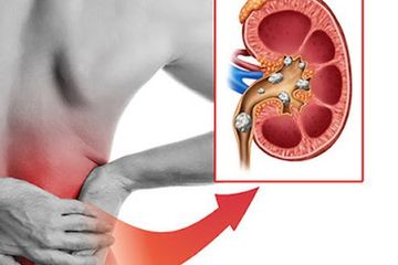 Makanan untuk Obat Batu Ginjal, Cuma dengan Bahan Alami ini Bisa Bantu Lawan Penyakitnya Tanpa Obat