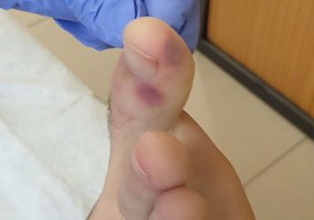 Ahli Medis Sebut Lesi Mirip Cacar Air pada Kaki Bisa Menjadi Gejala Baru Virus Corona