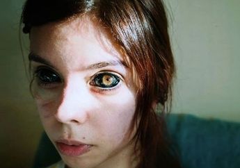 Seorang Model Wanita yang Masih Muda Mengalami Kebutaan setelah Lakukan Tato Bola Mata, Meski Sempat Menjadi Trend, Ternyata Ini Bahaya Tindakan Tato yang Satu Ini