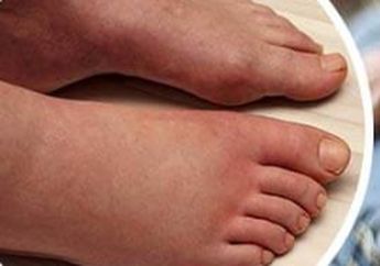 Setelah Berlama-lama Duduk, Perhatikan Kaki Anda Apakah Membengkak? Bisa Jadi Anda Alami Edema, Ini 7 Solusi Alami untuk Mengatasinya