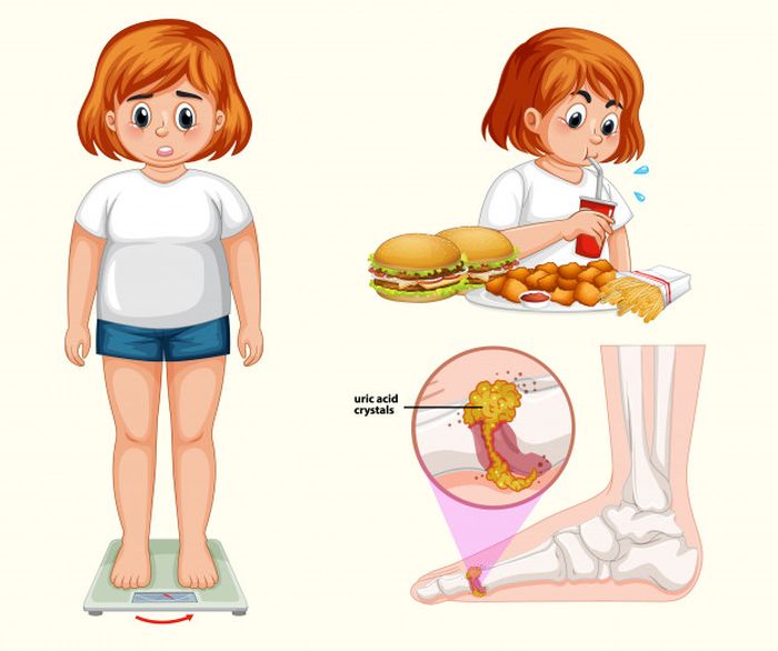 Ilustrasi. Kadar purin yang tinggi di dalam tubuh, akan tersimpan dan mengendap di persendian. Hal inilah yang menyebabkan asam urat.