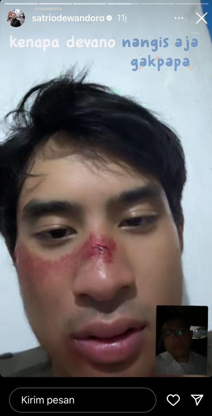 Suami Iis Dahlia unggah video Devano dengan wajah berdarah-darah