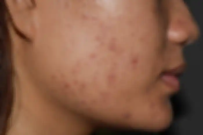 Cara hilangkan bekas jerawat hitam di pipi