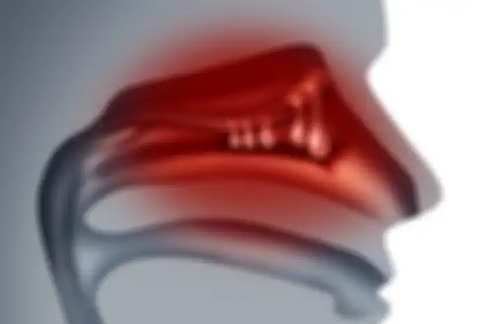 Ilustrasi polip hidung