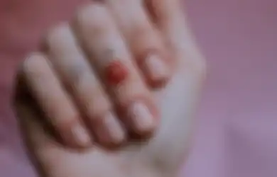 Belajar dari Wanita Ini, Kondisi yang Dianggap Biasa Ternyata Awal Gejala Penyakit Mengerikan, Buruan Cek Kuku Jarimu Sebelum Terlambat