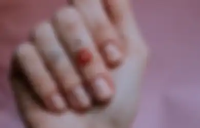 Belajar dari Wanita Ini, Kondisi yang Dianggap Biasa Ternyata Awal Gejala Penyakit Mengerikan, Buruan Cek Kuku Jarimu Sebelum Terlambat