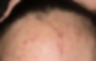 Inilah 5 Perbedaan Fungal Acne Sama Jerawat Biasa, Lengkap dengan Cara Mengatasinya