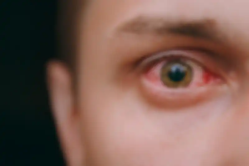 Konjungtivitis.