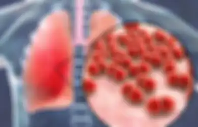Mematikan! Pneumonia dan 3 Penyakit Ini Muncul Akibat Infeksi Bakteri