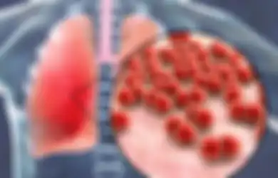 Mematikan! Pneumonia dan 3 Penyakit Ini Muncul Akibat Infeksi Bakteri