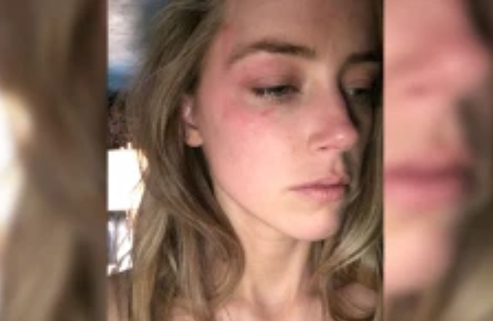Bukti pemukulan yang dilakukan Johnny Depp terhadap Amber Heard