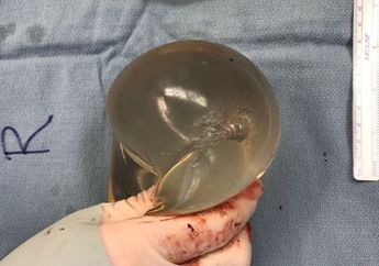 Tak Disangka, Implan Payudara Selamatkan Hidup Wanita Ini dari Penembakan yang Terjadi di Kanada