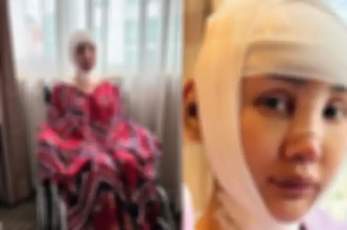 Lucinta Luna lakukan operasi plastik lagi