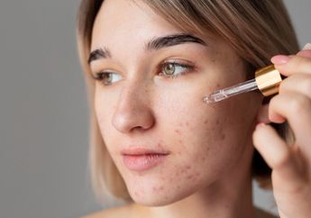 Simak! Ini Dia 4 Rekomendasi Obat Jerawat Salicylic Acid yang Ampuh Hempaskan Jerawat!