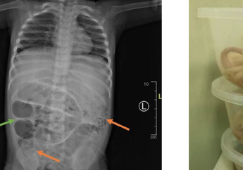 Penyebab Perut Balita di Jember Dipenuhi Cacing hingga Membesar, Kasusnya Kini Jadi Jurnal Ilmiah