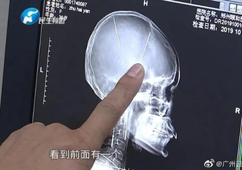 Jalani CT Scan Meski Tak Cedera Usai Kecelakaan Mobil, Wanita ini Kaget karena Ada Dua Jarum Tertanam di Otaknya Selama Puluhan Tahun 