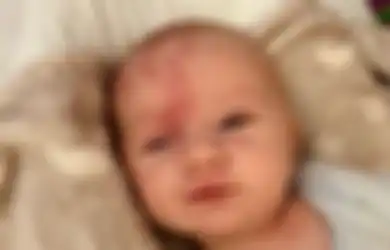 Bayi Ini Lahir Dengan Tanda Seperti 'Bekas Anggur' Di Wajahnya, Tidak Disangka Ternyata Menderita Sindrom Penyakit Langka Ini Sampai Mengalami Kejang Hampir Satu Jam