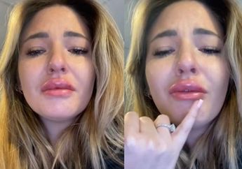 Rogoh Kocek Sampai Rp 93 Juta Demi Dapat Bibir Seksi, Perempuan Ini Malah Naik Pitam Tahu Hasilnya, Diolok Mirip Tokoh Game Ini!