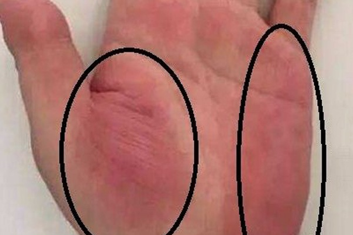 Tanda penyakit  dilihat dari telapak tangan.