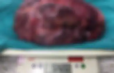 Mengeluh Sakit Perut yang Sangat Mencekam, Ternyata di Perut Pria Ini Ditemukan Tumor yang Beratnya Hampir Mencapai 6 Kilogram
