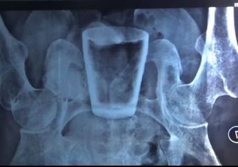 Aneh Tapi Nyata, Gelas Kaca Ditemukan di Dalam Perut Seorang Pria di Jember, Berawal dari Merasakan Sakit di Ulu Hati