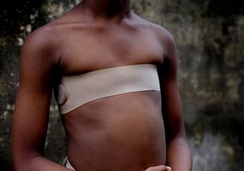 Tak Ingin Anaknya Menikah dengan Orang Lain, Seorang Ibu Tega Menyetrika Payudara Putrinya