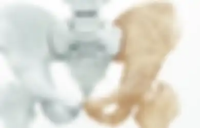 Mitos atau Fakta Osteoporosis, Penyakit yang Sering Disebut Silent Disease, Benarkah ini Penyebabnya?