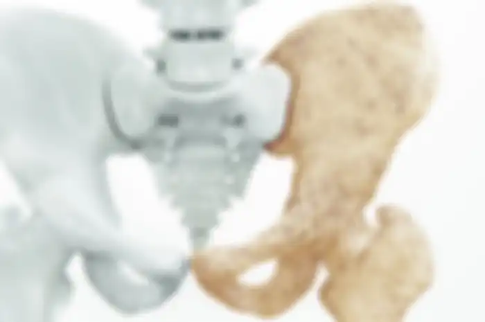 Ilustrasi osteoporosis