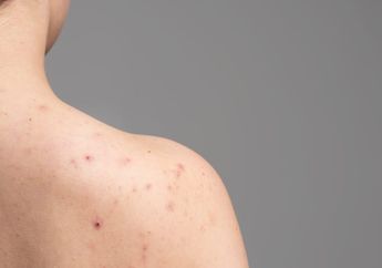 Bisa dengan Kompres Air Hangat hingga Memakai Cuka Sari Apel, Simak Cara Mengatasi Jerawat Punggung, Ternyata Punggung Juga Perlu Dijauhkan dari Hal Ini