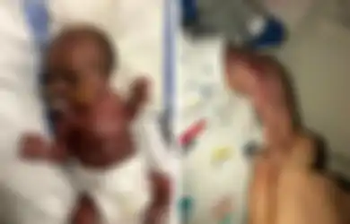 Terlahir Tanpa Kulit dan Digambarkan Seperti 'Daging Mentah', Bayi Ini Secara Ajaib Bisa Bertahan Hidup