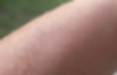 5 Cara Mengatasi Kulit Kering yang Disebabkan oleh Suhu Dingin