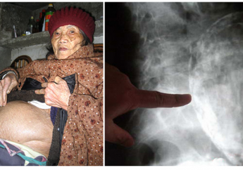 Kisah Aneh Seorang Nenek Hamil Selama 60 Tahun, Begitu Dilahirkan Kondisi Bayinya Sungguh Mengenaskan Tak Hanya Mati Tapi Begini Bentuknya