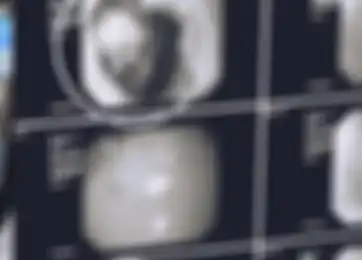 Hasil CT Scan 