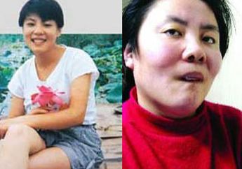 Diduga Jadi Korban Percobaan Pembunuhan Temannya Sendiri, Mahasiswi Berbakat Ini Diracun Bahan Kimia hingga Cacat Permanen!