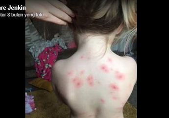 Bukan dengan Obat-obatan, Seorang Ibu Justru Sembuhkan Cacar Air Anaknya dengan Sampo, Begini Caranya