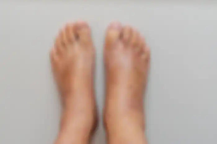 Ilustrasi kaki bengkak 