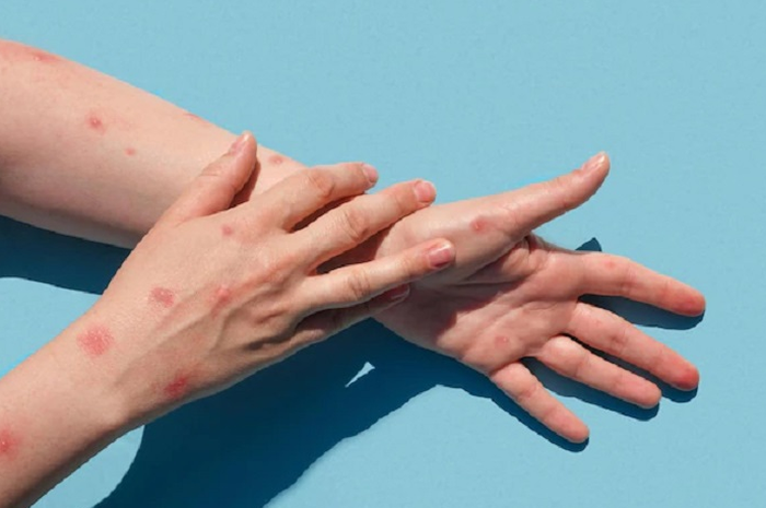 Cacar monyet atau monkeypox adalah salah satu virus yang ditetapkan sebagai darurat kesehatan global oleh WHO.