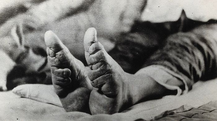 Praktik pengikatan kaki di Tiongkok dimulai sejak abad ke-10. Wanita menjalani proses menyakitkan agar mendapatkan kaki berukuran 10 sentimeter. Berlangsung hingga tahun 1949, mengapa praktik menyakitkan ini bisa bertahan selama satu milenium?