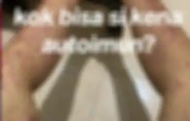 Viral Wanita Didiagnosis Autoimun usai Kakinya Dipenuhi Bercak Merah, Ngaku Sering Makan ini