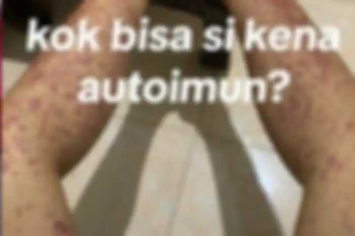 Kisah wanita bernama Della warga Sidoarjo, Jawa Timur menderita penyakit autoimun. 