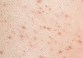Bukan Krim Mahal Ratusan Ribu, Jerawat di Punggung Hilang Seketika dengan Andalkan Bahan Alami Ramah Kantong Berikut Ini
