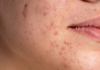 Arti Mimpi Jerawat Lengket Kaitannya dengan Masalah Kesehatan, Harap Tetap Waspada Terhadap Adanya Kebohongan hingga Masalah Nutrisi Buruk