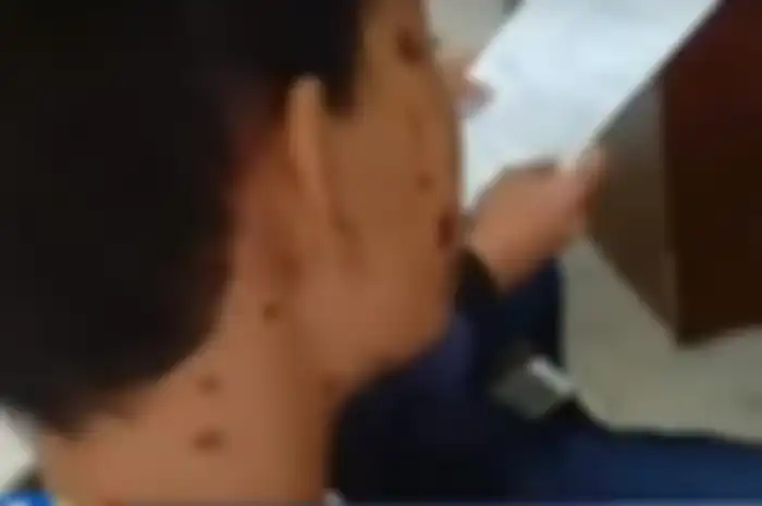 Dua pemuda disiram cuka para gara-gara tegur pemotor yang ugal-ugalan di Palembang.