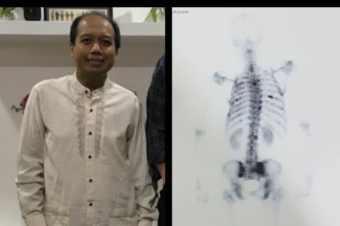 Kanker paru renggut nyawa Sutopo