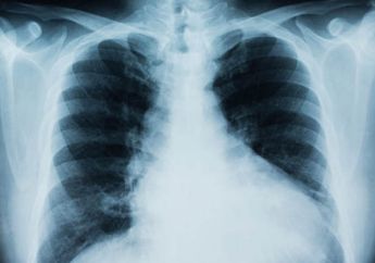 Kurangi Sebelum Terlambat! Siapa Sangka Makanan yang Sering Dikonsumsi Masyarakat Indonesia Ini Bisa Tingkatkan Risiko Kanker Paru-paru